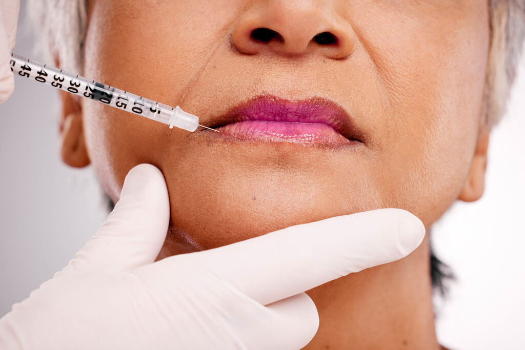Dermal Fillers at Burlington Skin Clinic